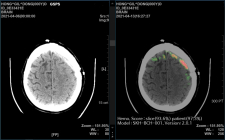 SK㈜ C&C, ‘AI 뇌출혈 영상 의료 솔루션’ 효과 글로벌 논문 게재